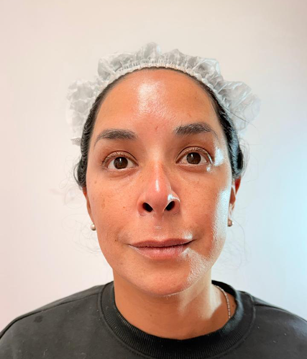 Después: toxina botulínica